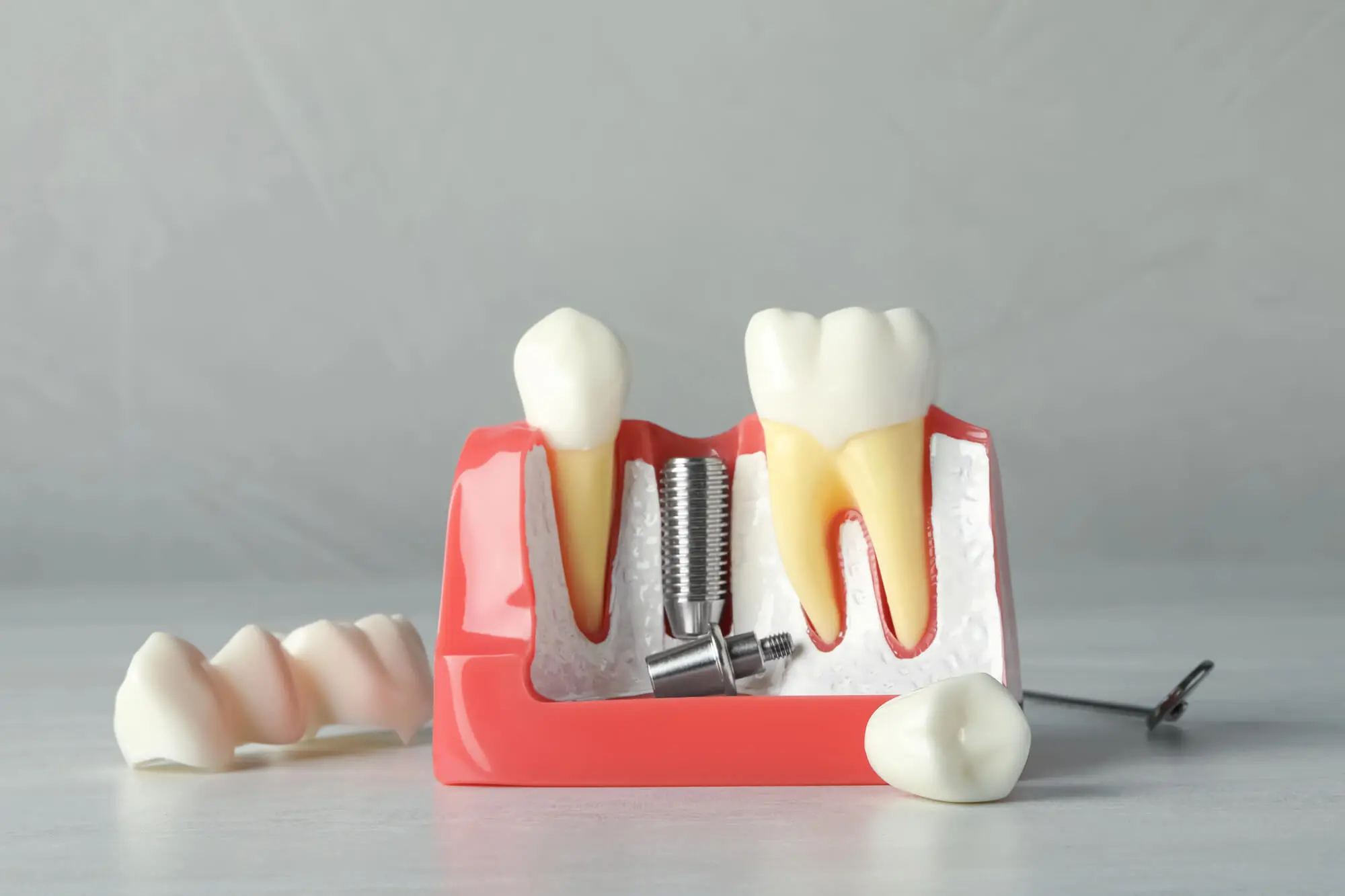 Dental Implants in Grosse Pointe MI
