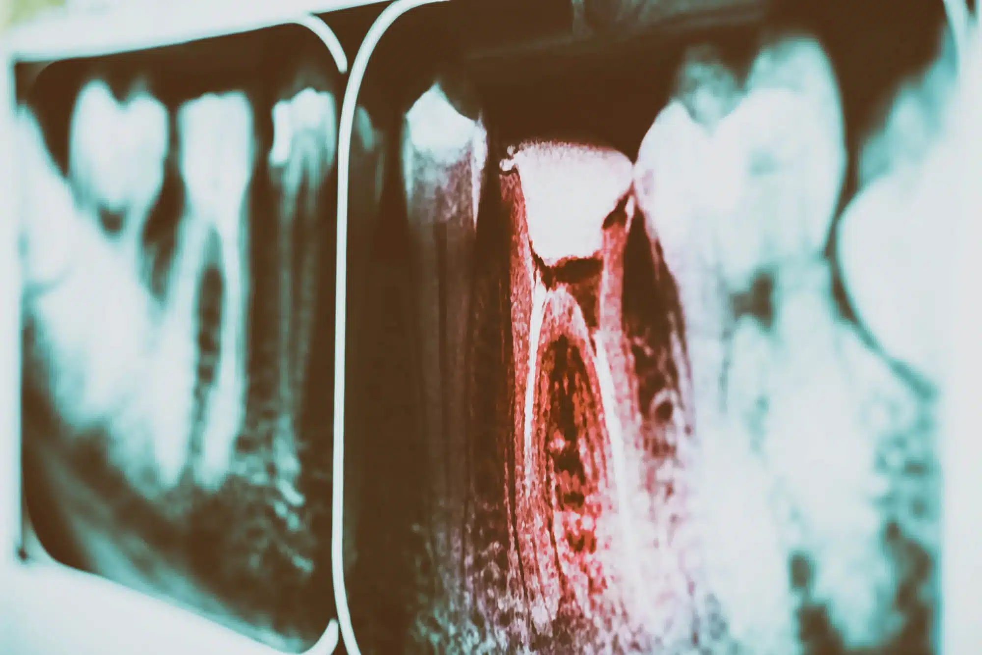 needing Dental Crowns in Grosse Pointe, MI