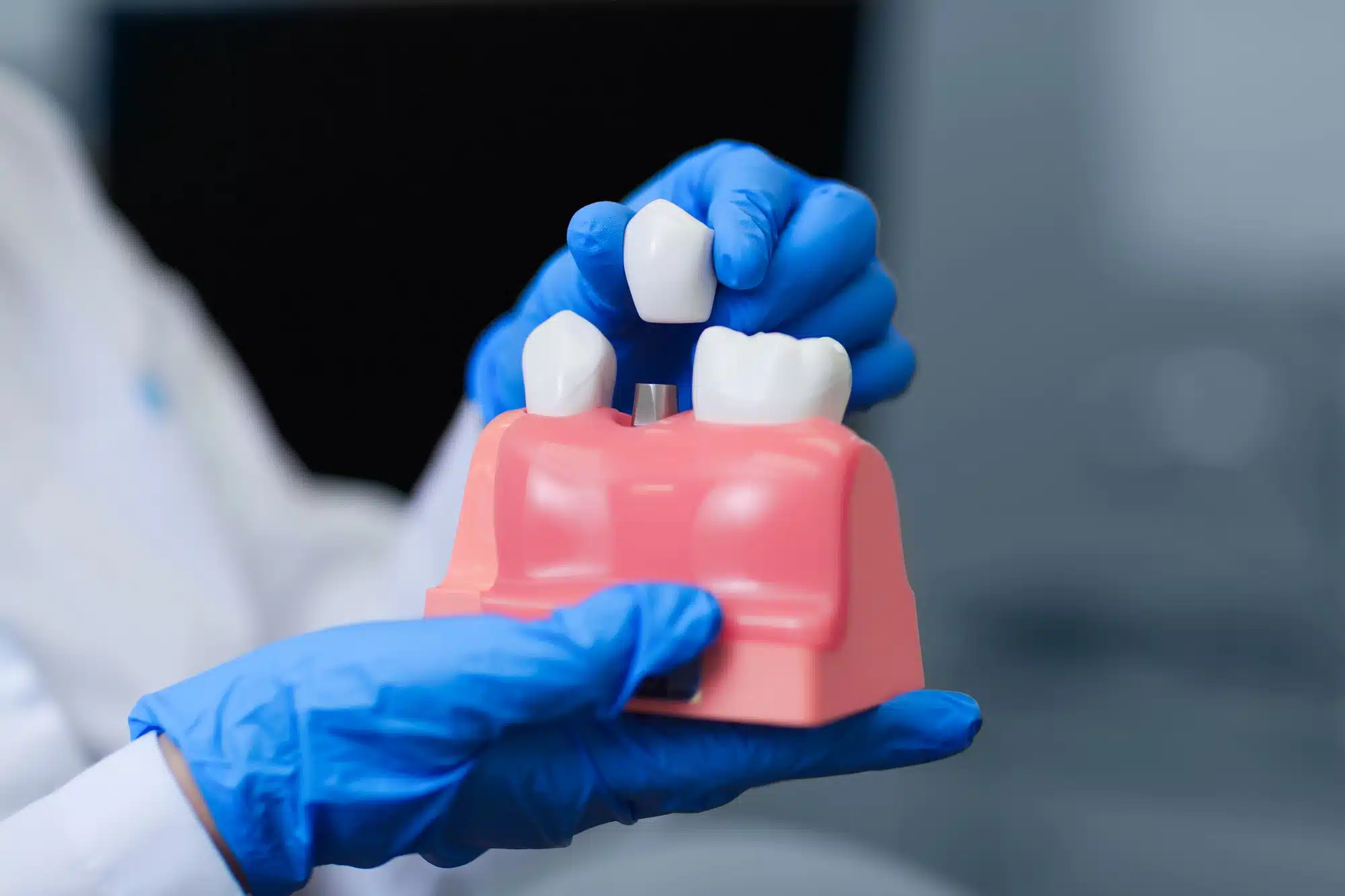model of dental implants in Grosse Pointe, MI